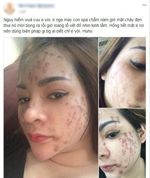 Nghe lời nhân viên spa chấm nám cho đẹp da, cô gái trẻ bị thui cháy loang lổ cả mặt Nghe lời nhân viên spa chấm nám cho đẹp da, cô gái trẻ bị thui cháy loang lổ cả mặt