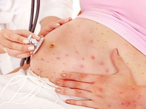 Phụ nữ mang thai mắc thủy đậu có nguy hiểm?