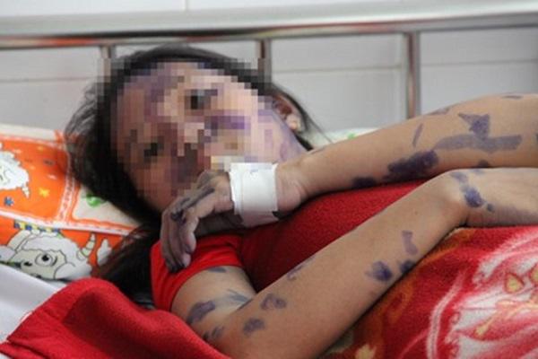 Cô gái trẻ nguy kịch vì biến chứng không ngờ của bệnh thủy đậu