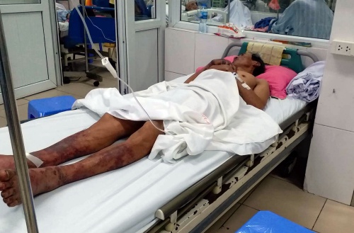 Người đàn ông bị liên cầu khuẩn từ lợn xâm nhập qua vết xước trên tay