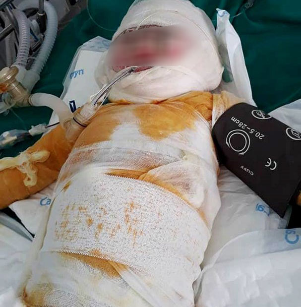 Bé gái 2,5 tuổi bị bỏng hố vôi đã qua đời