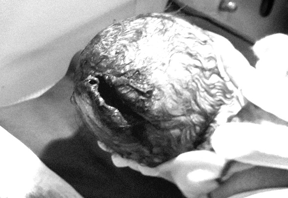 Dùng dao giúp con dâu sinh nở, bà nội làm rách da đầu cháu bé