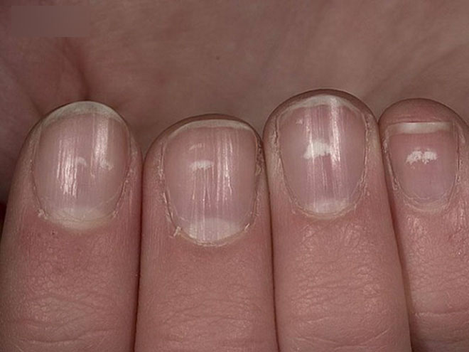 Nếu gan sinh bệnh hoặc nhiễm độc, móng tay sẽ có 3 thay đổi bất thường dễ nhận biết