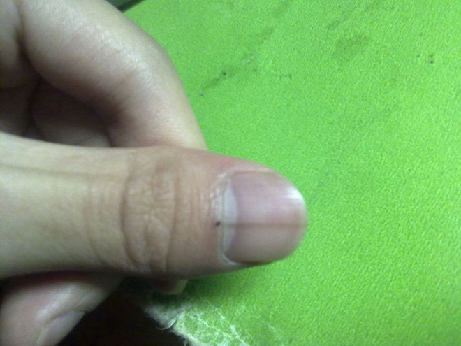 Nếu gan sinh bệnh hoặc nhiễm độc, móng tay sẽ có 3 thay đổi bất thường dễ nhận biết