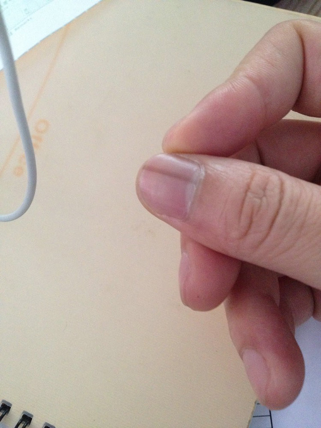 Nếu gan sinh bệnh hoặc nhiễm độc, móng tay sẽ có 3 thay đổi bất thường dễ nhận biết