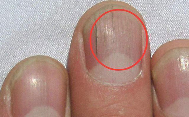 Nếu gan sinh bệnh hoặc nhiễm độc, móng tay sẽ có 3 thay đổi bất thường dễ nhận biết Nếu gan sinh bệnh hoặc nhiễm độc, móng tay sẽ có 3 thay đổi bất thường dễ nhận biết