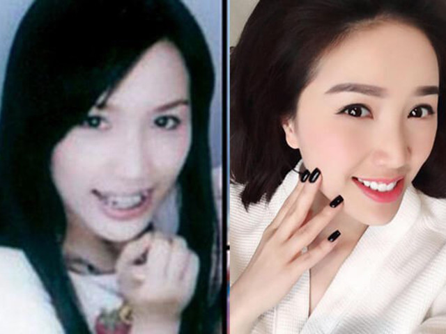 Chỉ cần làm răng, loạt sao Việt đã lên đời nhan sắc thế này!