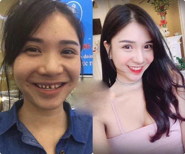 Chỉ cần làm răng, loạt sao Việt đã lên đời nhan sắc thế này!