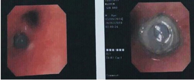 Viên đạn súng hơi nằm sâu trong phế quản bé trai 4 tuổi cả tháng nhưng người nhà không hay