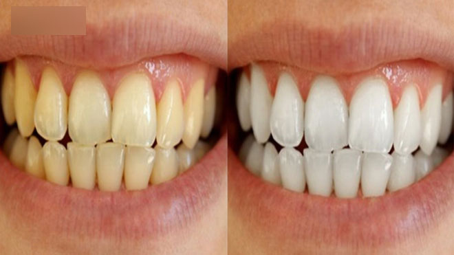 8 cách làm trắng răng hiệu quả và an toàn tại nhà: Lưu lại để dùng khi cần đến 8 cách làm trắng răng hiệu quả và an toàn tại nhà: Lưu lại để dùng khi cần đến