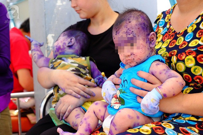 Đau lòng trước những hậu quả trẻ sơ sinh gánh phải khi người lớn cuồng phương pháp thuận tự nhiên