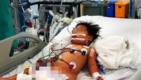 Uống nhầm xăng, bé 17 tháng tuổi nhập viện trong tình trạng nguy kịch