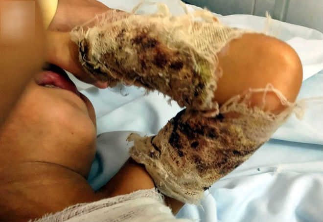 Đòi đến trường đón anh tan học, bé trai 3 tuổi bất ngờ vấp, ngã cả người vào nồi nước sôi bên đường