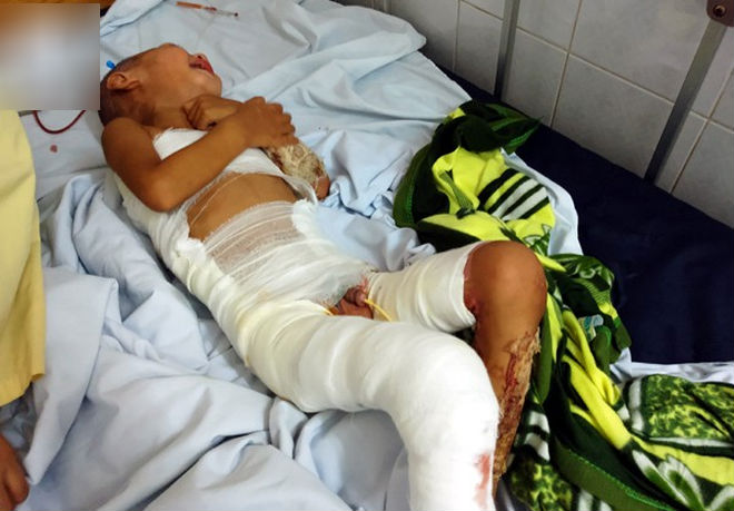 Đòi đến trường đón anh tan học, bé trai 3 tuổi bất ngờ vấp, ngã cả người vào nồi nước sôi bên đường