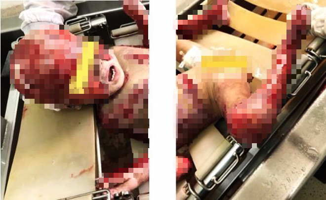 Thương tâm cha lóc da cứu con trai 3 tuổi bỏng toàn bộ cơ thể vì cháy nhà