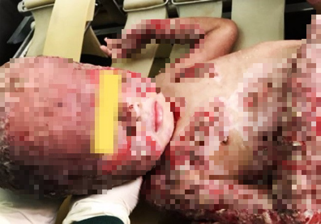 Thương tâm cha lóc da cứu con trai 3 tuổi bỏng toàn bộ cơ thể vì cháy nhà