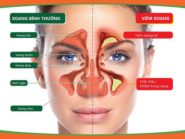 Cậu bé mất mạng vì viêm xoang, nhiều mẹ hoang mang, lo lắng