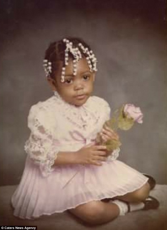 Đừng coi thường bệnh thủy đậu, người phụ nữ này đã phải trải qua gần 30 năm sống trong đau đớn chỉ vì mắc chứng bệnh này năm 8 tuổi