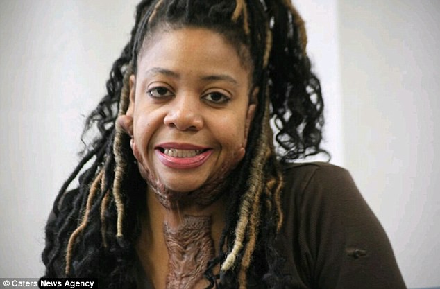 Đừng coi thường bệnh thủy đậu, người phụ nữ này đã phải trải qua gần 30 năm sống trong đau đớn chỉ vì mắc chứng bệnh này năm 8 tuổi