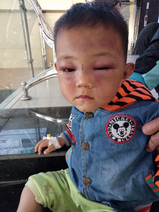 Tạm giữ bố dượng đánh con riêng 2 tuổi của vợ đến mức phải nhập viện