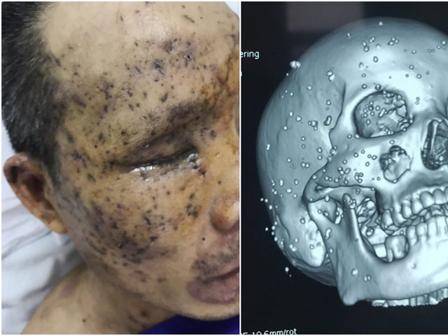 Cực kỳ hy hữu: Người đàn ông bị 100 mảnh kim loại, cục than găm nát mặt