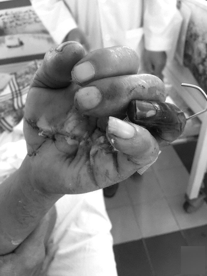 Tai nạn kinh hoàng: Người đàn ông ở Bình Dương bị máy cưa cắt đứt lìa tay