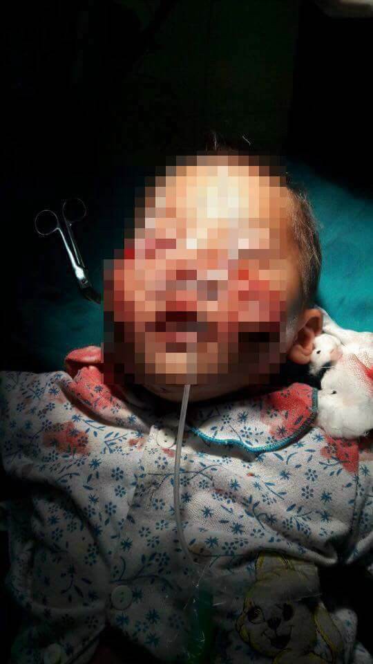 Sang nhà chú ruột chơi, bé trai 3 tuổi bị hai con chó cắn rách mặt phải nhập viện cấp cứu