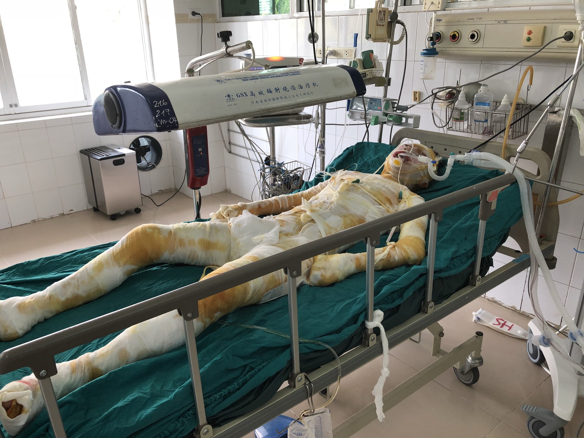 Cô gái bị tẩm xăng thiêu sống trong lúc ngủ sức khỏe chuyển biến xấu, mất nhận thức, hoàn toàn bất tỉnh