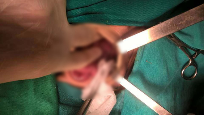 Lào Cai: Cứu sống bé sơ sinh nặng 1,7kg bị vỡ dạ dày