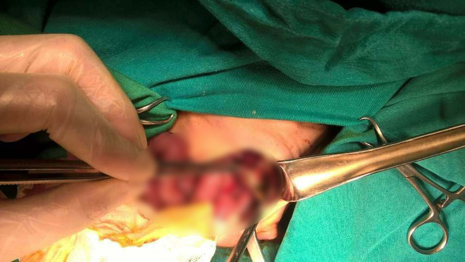 Lào Cai: Cứu sống bé sơ sinh nặng 1,7kg bị vỡ dạ dày