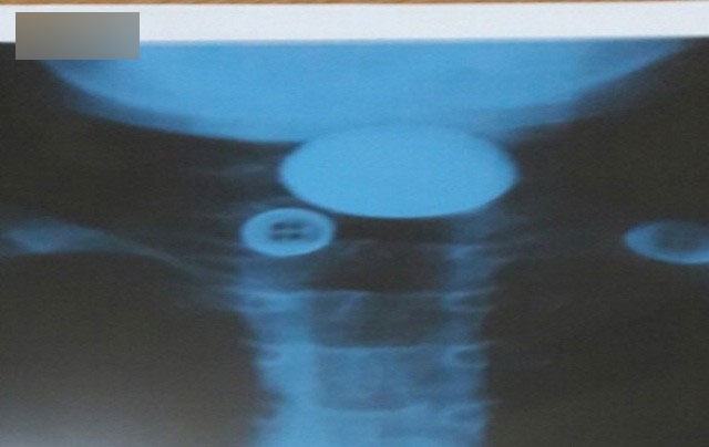 Hà Nội: Bé trai 7 tuổi phải nhập viện cấp cứu vì đồng xu mắc ngang cổ