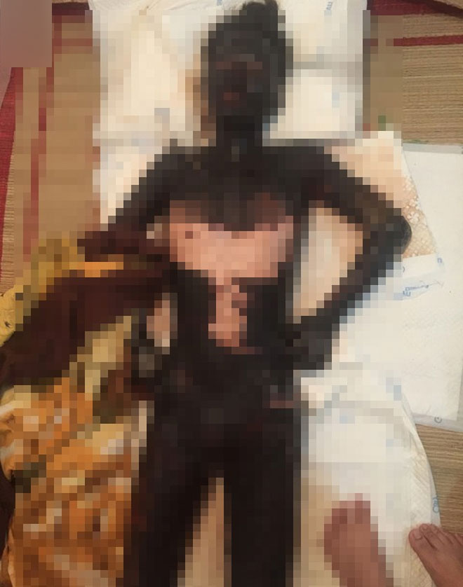 Tận cùng nỗi đau của cô gái trẻ bị người yêu tẩm xăng đốt khiến toàn thân cháy đen