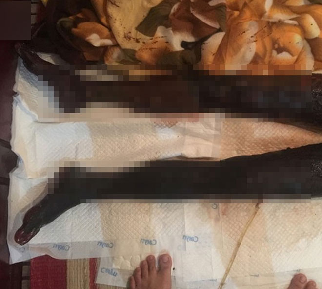 Tận cùng nỗi đau của cô gái trẻ bị người yêu tẩm xăng đốt khiến toàn thân cháy đen