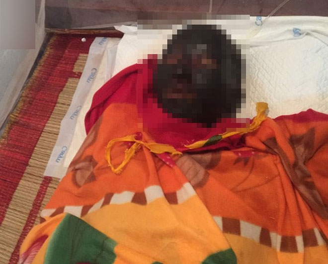 Tận cùng nỗi đau của cô gái trẻ bị người yêu tẩm xăng đốt khiến toàn thân cháy đen