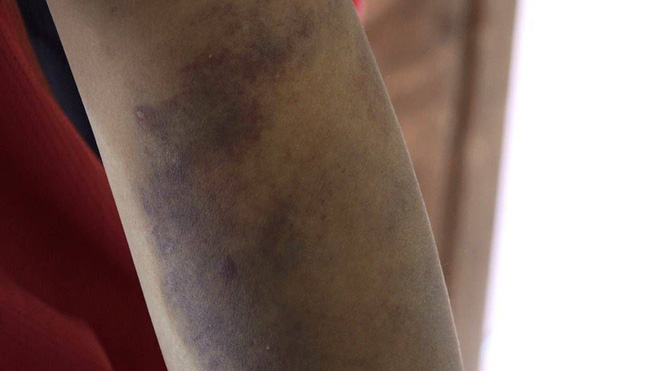 Hà Nội: Bố đẻ cùng mẹ kế đánh đập bé trai 14 tuổi bầm tím khắp cơ thể