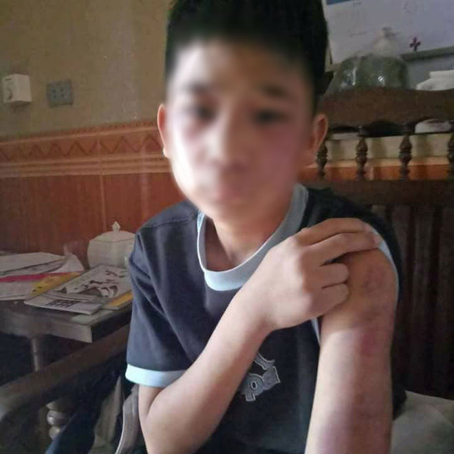 Hà Nội: Bố đẻ cùng mẹ kế đánh đập bé trai 14 tuổi bầm tím khắp cơ thể