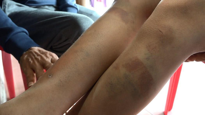 Người nhà bé trai bị bạo hành nói bố đẻ, mẹ kế không cho tiếp xúc với ai