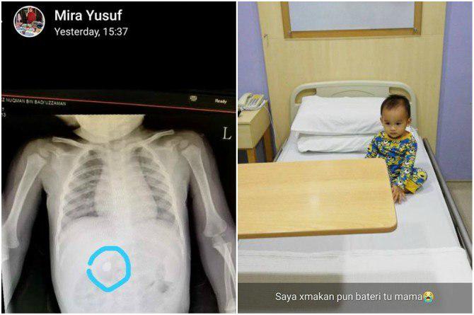 Cục pin đổi màu, rỉ sét chỉ sau 1 ngày nằm trong bụng bé trai