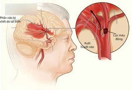 Chuyên gia tim mạch: Nhiều trường hợp bị nguy hiểm vì uống An cung ngưu hoàn phòng đột quỵ
