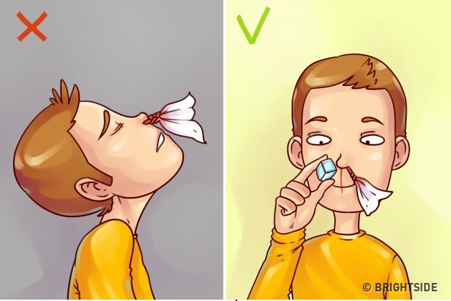 Để chảy máu cam chấm dứt không phải ngửa đầu ra sau, đây mới là cách sơ cứu đúng!