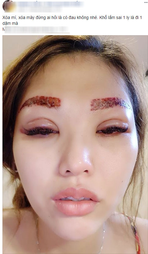 Muốn xăm mí mắt, lông mày cho giống Hồ Ngọc Hà, ai ngờ bị hỏng, cô gái lại chịu bao đau đớn để xóa xăm