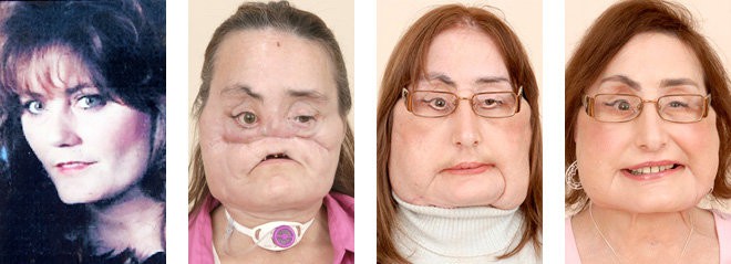 Gã chồng ghen tuông san phẳng khuôn mặt vợ, 4 năm sau điều không tưởng đã xảy ra