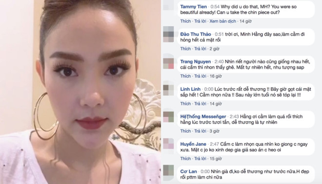 Minh Hằng khiến khán giả hốt hoảng vì cằm nhọn nhìn như bị lệch