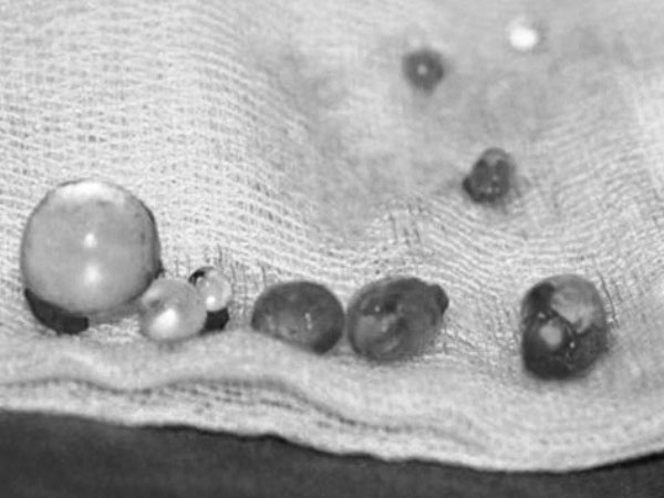 19 tháng, 126 người đàn ông bị bướu tinh hoàn đến bệnh viện ở TP.HCM cầu cứu