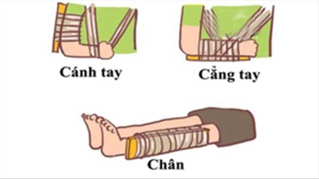 Hướng dẫn sơ cứu đúng cách cho trẻ bị gãy xương