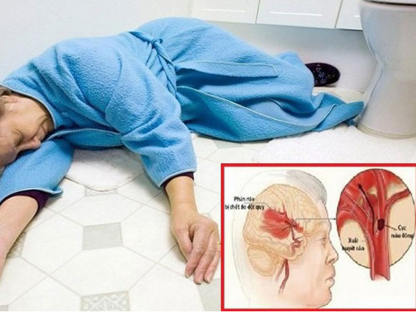 Đột quỵ cướp đi sinh mạng 100.000 người Việt một năm