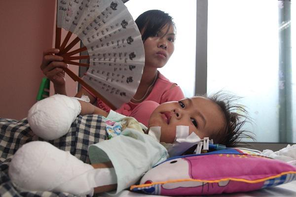 Sau 1 cơn sốt ban đêm, mẹ hoảng sợ thấy chân tay con gái 3 tuổi tím đen, hoại tử Sau 1 cơn sốt ban đêm, mẹ hoảng sợ thấy chân tay con gái 3 tuổi tím đen, hoại tử