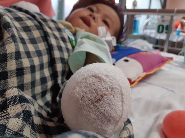 Sau 1 cơn sốt ban đêm, mẹ hoảng sợ thấy chân tay con gái 3 tuổi tím đen, hoại tử