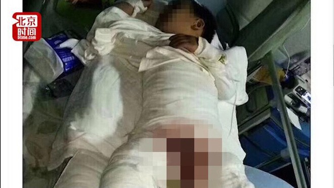 Bé 4 tuổi bị bỏng toàn thân ở trường mẫu giáo và sự thật gây phẫn nộ