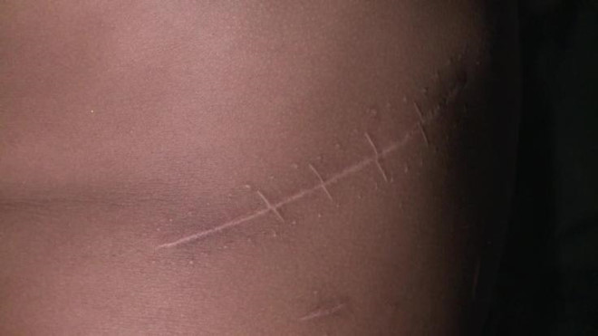 Mua bán thận núp bóng hiến tạng nhân đạo bị xử lý thế nào?